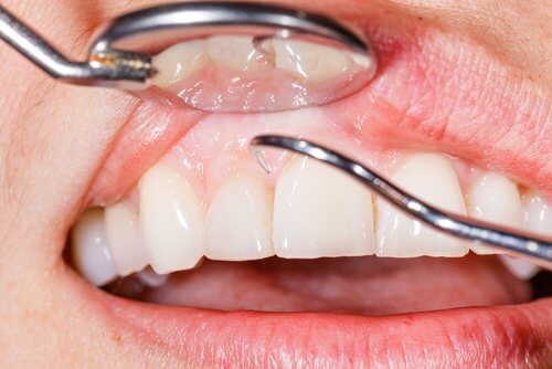Gingiile inflamate pot fi semnul unui ficat suprasolicitat