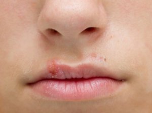 Cum să scapi de herpes într-o noapte