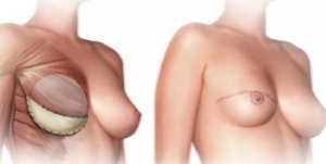 Ce trebuie să știi despre operația de mastectomie