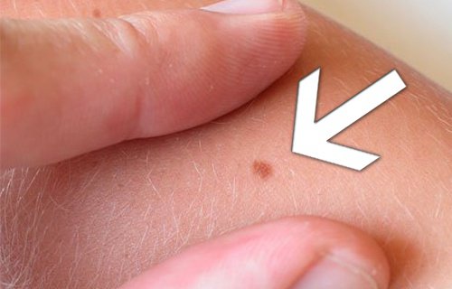Un medic dermatolog poate trata alunițe