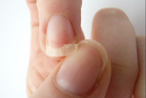 Un medic dermatolog poate te poate sfătui cu privire la sănătatea unghiilor