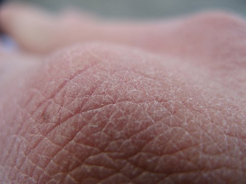 Pielea uscată pe lista de simptome ale diabetului