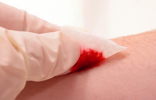 Rănile care se vindecă greu sunt un motiv de a merge la medic dermatolog