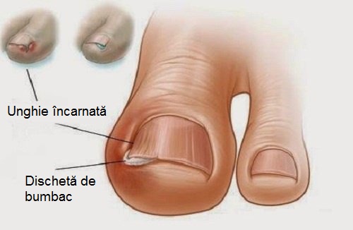 Infectie unghie picior copii