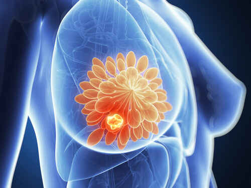 Sân afectat de cancer