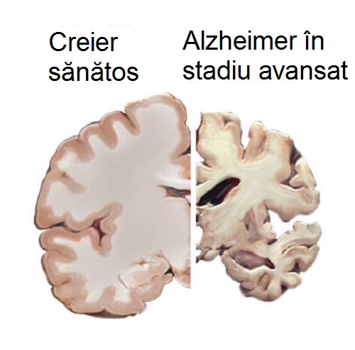 Boala Alzheimer deteriorează creierul 