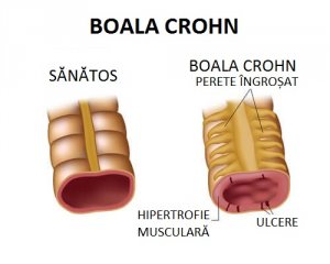 Boala Crohn - dietă care te ajută să o tratezi