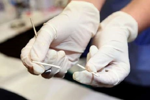 Implantul contraceptiv și îndepărtarea sa