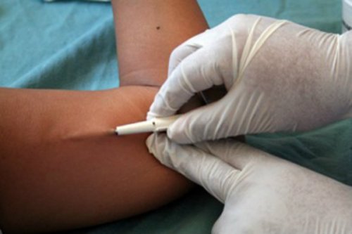 Implantul contraceptiv introdus sub piele