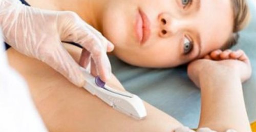 Implantul contraceptiv subdermic cu progesteron