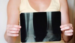 Cum se menține densitatea osoasă după menopauză?