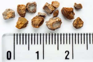 Pietre la rinichi: 6 remedii naturale