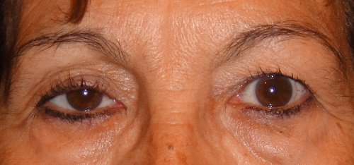 Pleoapele căzute pot indica o problemă cu ochii