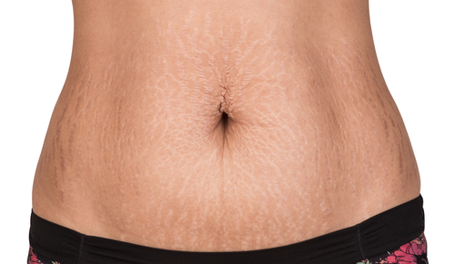 Două remedii naturale simple pentru vergeturi