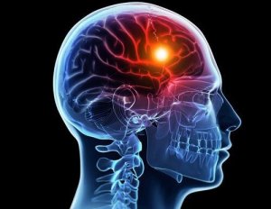 8 semne care anunță un accident vascular cerebral