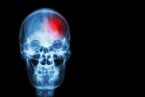 Accidentele vasculare cerebrale: 5 semnale de alarmă