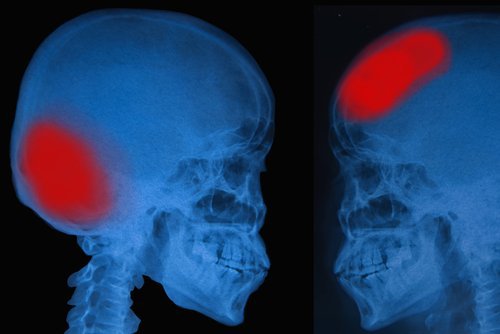 Accidentele vasculare cerebrale reprezintă o problemă foarte gravă