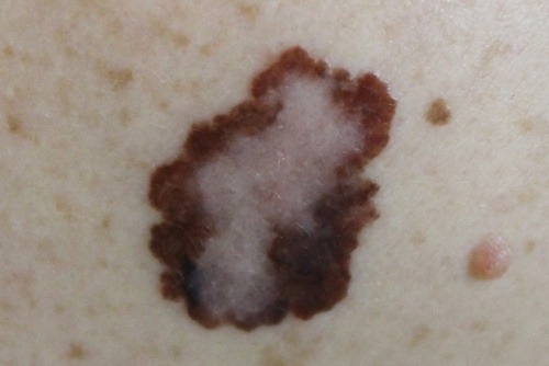 Cancerul de piele se poate dezvolta la nivelul unei alunițe