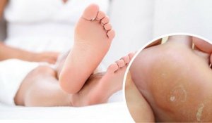 Remedii pentru bătăturile de la picioare 100% naturale