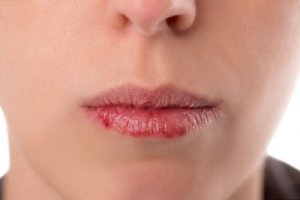 Cancerul orofaringian: simptome principale
