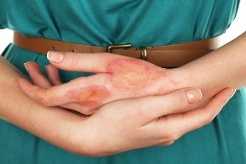 Cancerul de piele poate fi provocat de o infecție