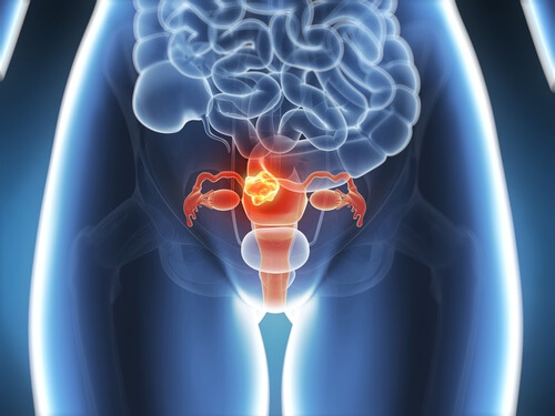 6 dintre simptomele cancerului cervical