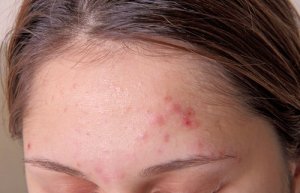 Supraîncărcarea cu toxine – 9 simptome