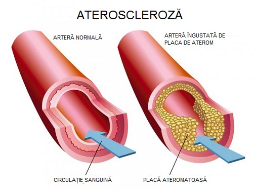 Tratament pentru colesterolul rău și legătura cu ateroscleroza
