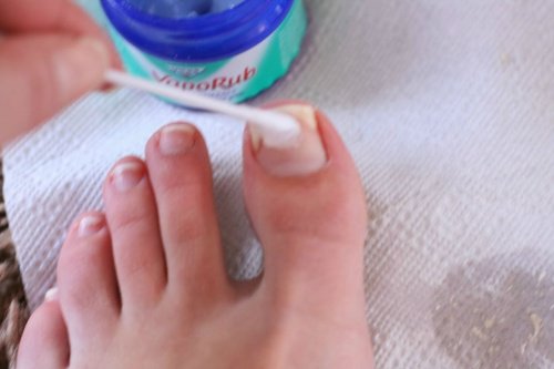 Unguentul VapoRub tratează ciuperca unghiei