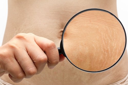 Vergeturile apar de multe ori pe abdomen