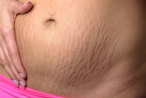 Două remedii naturale simple pentru vergeturi