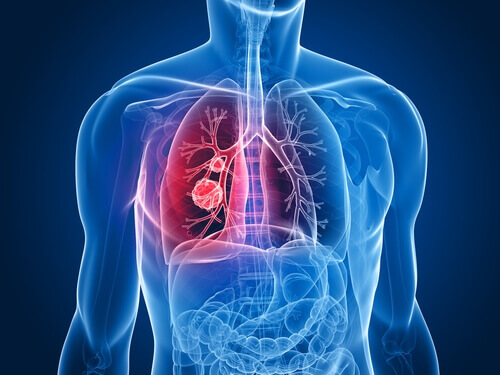Cancerul pulmonar la femei