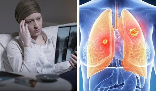 Cancerul pulmonar – riscuri pentru femei