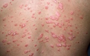 Ce este psoriazisul și câte tipuri există?