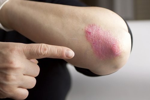 Leziuni date de psoriazisul cu plăci