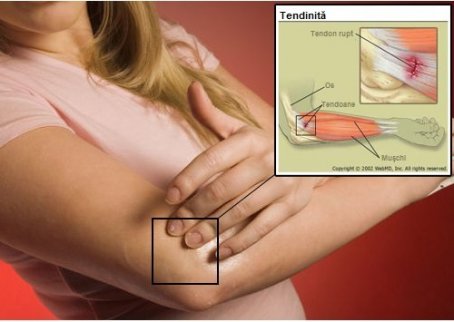 artroza articulației gleznei este periculoasă tratați articulațiile cu tencuieli de muștar