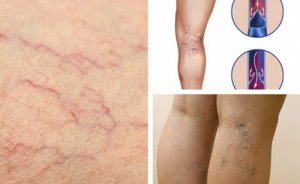 5 obiceiuri pentru vene mai sănătoase