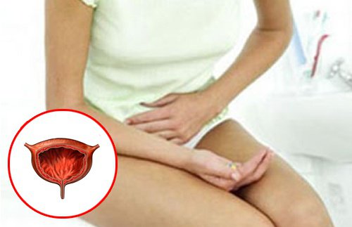 Fibroamele uterine produc mai multe simptome