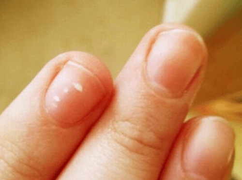 Factori care provoacă petele albe de pe unghii
