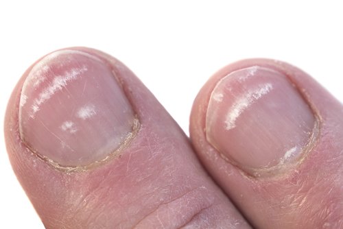 Petele albe de pe unghii – cauze și prevenție