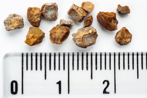 Modalități de a preveni formarea pietrelor la rinichi