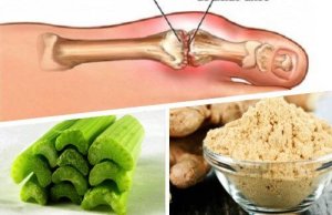 Remediu natural pentru a elimina cristalele de acid uric