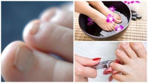 Ciuperca unghiei: 7 informații importante