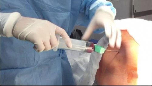 Donator de măduvă osoasă sub anestezie