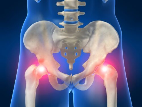 Durerea de șold poate fi cauzată de osteoartrită
