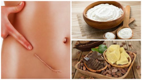 7 remedii naturale care diminuează cicatricile