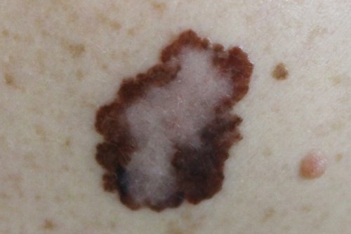 Melanomul pe lista de simptome ale cancerului de piele