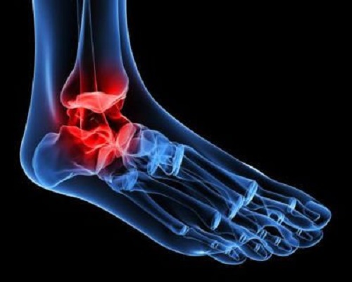 Osteoartrita gleznei poate fi cauzată de mai mulți factori
