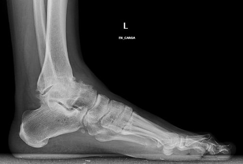 Osteoartrita gleznei trebuie tratată în mod adecvat