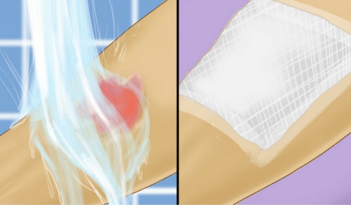 Primul ajutor în caz de arsuri prin opărire